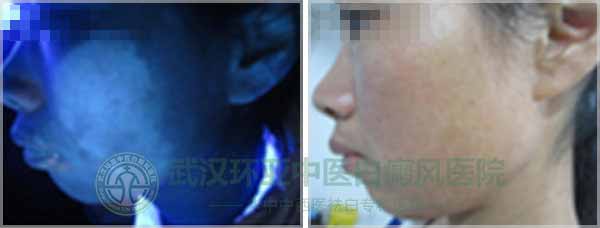 环亚祛白就像变魔术 30多天白癜风不见了