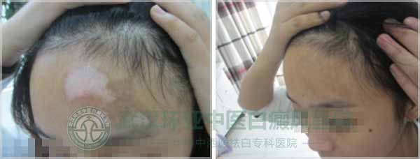 自卑白癜风少女重获健康