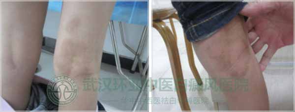 误青春受折磨,白癜风非去不可!