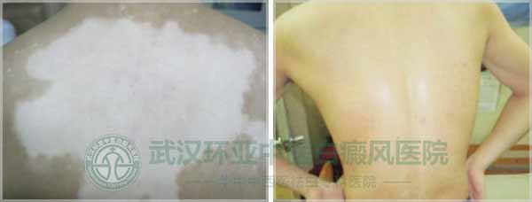 背部大面积白斑在环亚得到根治