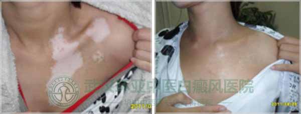 因为白癜风被悔婚,少女5年没睡过好觉